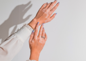 Vitiligo